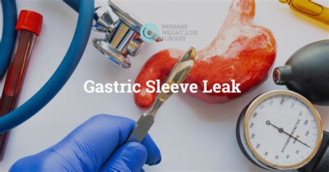 gastric sleeve leak|Gastric Leak Post